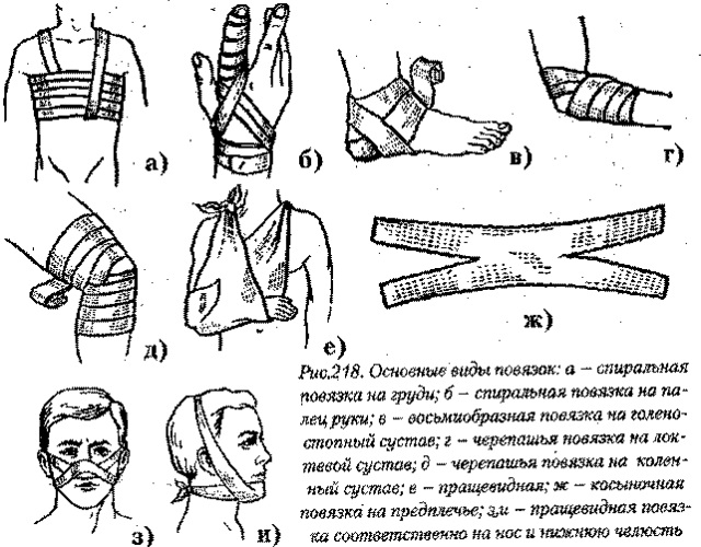 Повязки по хирургии алгоритм с картинками