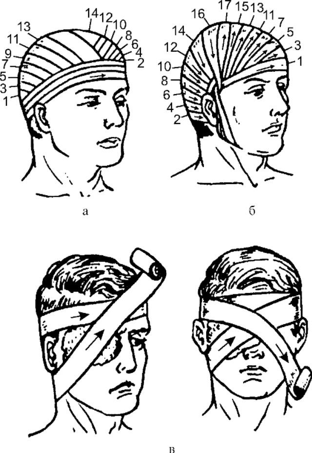 Способы повязки. Шапочка Гиппократа повязка черепашья. Десмургия чепец. Десмургия шапочка Гиппократа. Десмургия чепец техника.